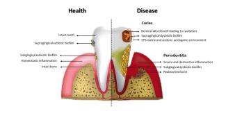 Caries and Periodontitis